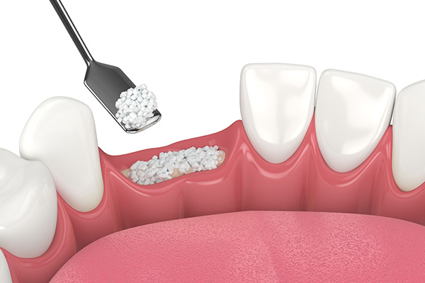 3D model of bone graft being performed on the area where teeth are missing.