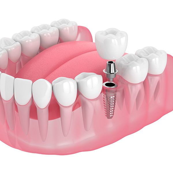 Dental Implants diagram at Periodontal Surgical Arts.