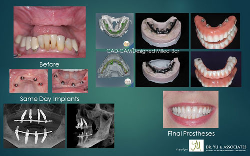 Case study of all on 4 implants