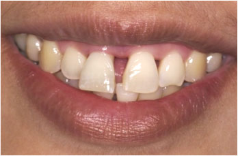 Before picture of a smile of a patient with short loose teeth at Periodontal Surgical Arts in Austin, TX