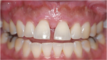 After picture of a smile of a patient with short loose teeth.