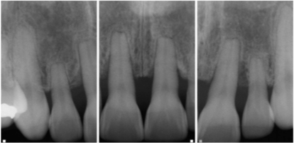 Before x-ray of a patient with sort loose teeth.