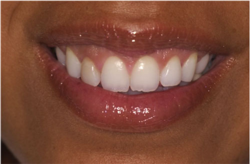 After: The shape of teeth appear more natural after crown lengthening at Periodontal Surgical Arts in Austin, TX