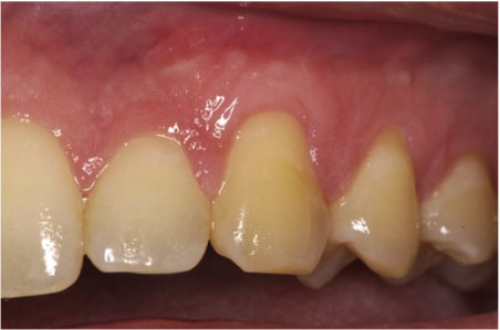 AFTER: The grafted gums appear natural.