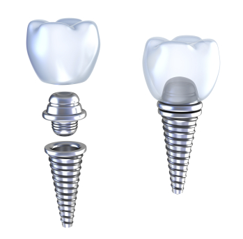 Dental implant diagram of implants being attached together.