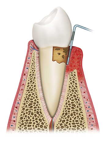 A diagram of a tooth with periodontal issues being examined using dental tool.