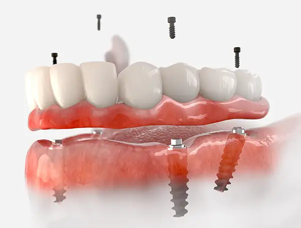 An upper arch All-on-4 dental implant system with screws being placed into the jawbone illustrated by Periodontal Surgical Arts in Austin, TX