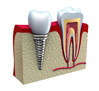 3D model of a cross section of dental implant tooth and normal tooth