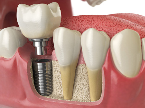 3D model of implant cross section in lower jaw at Periodontal Surgical Arts in Austin, TX