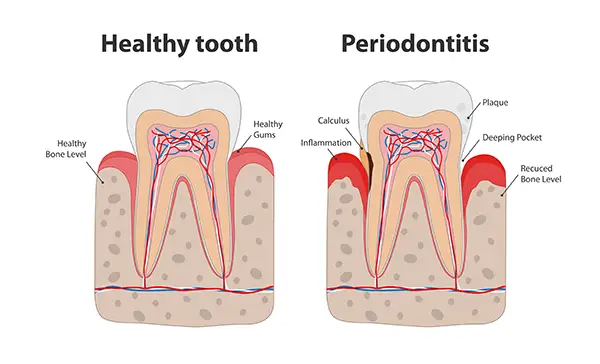 Diagram comparing a healthy tooth with one affected by periodontitis illustrated by Periodontal Surgical Arts in Austin, TX